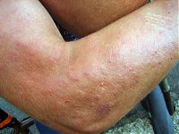 Ranall's arm